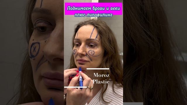Омоложение верхней трети лица #подтяжкабровой  #пластикавек #липофилинг