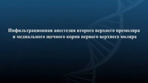 Инфильтрационная анестезия  в стоматологии