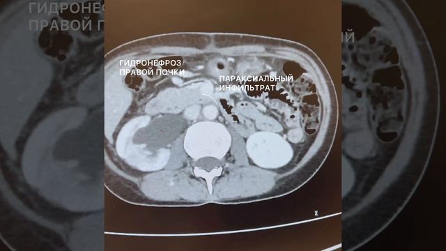 Гидронефроз правой почки и параксиальный инфильтрат вдоль нижней полой вены