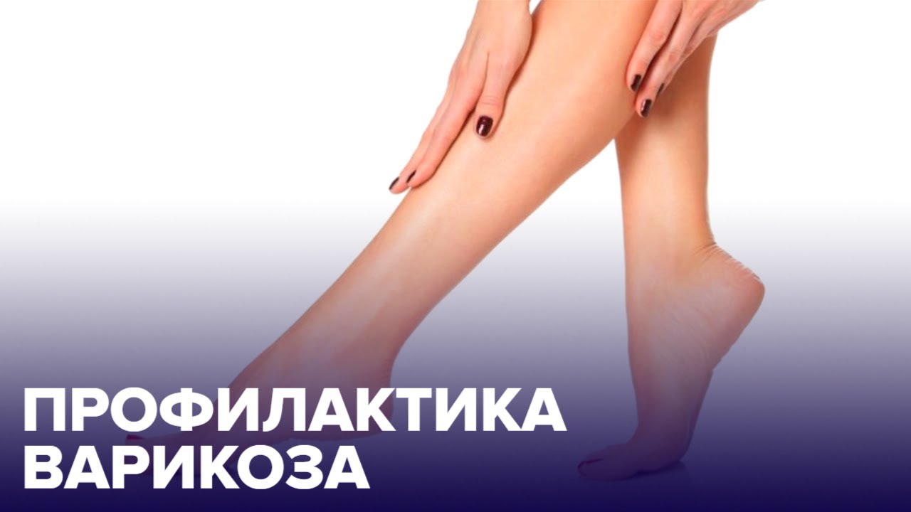 Как ЗАЩИТИТЬСЯ от ВАРИКОЗА?