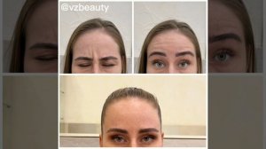 Результат инъекций ботулотоксина «Миотокс» в зону лба и межбровья