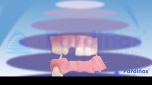 Частичный съемный протез ©