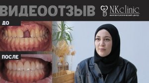 Как проходило лечение рецессии десны и нарушения прикуса