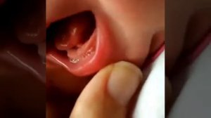 Короткая уздечка языка. Уздечка языка у новорождённого.