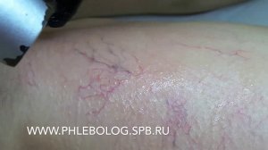 Удаление сосудистых звездочек на ногах лазером