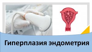 Гиперплазия эндометрия.