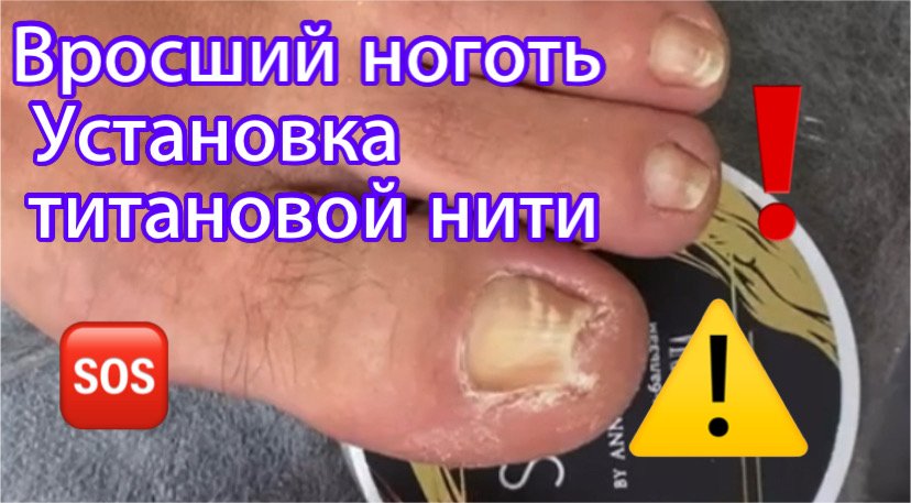 Вросший ноготь🆘⚠️ ️• Установка титановой нити🦶🏻 смотреть онлайн видео ...