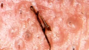 Удаление вросших волос