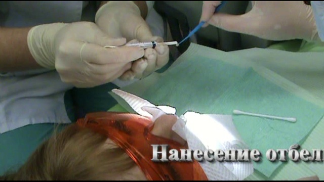 Офисное (клиническое) отбеливание зубов