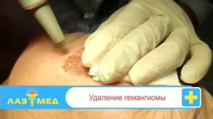 Удаление гемангиомы
