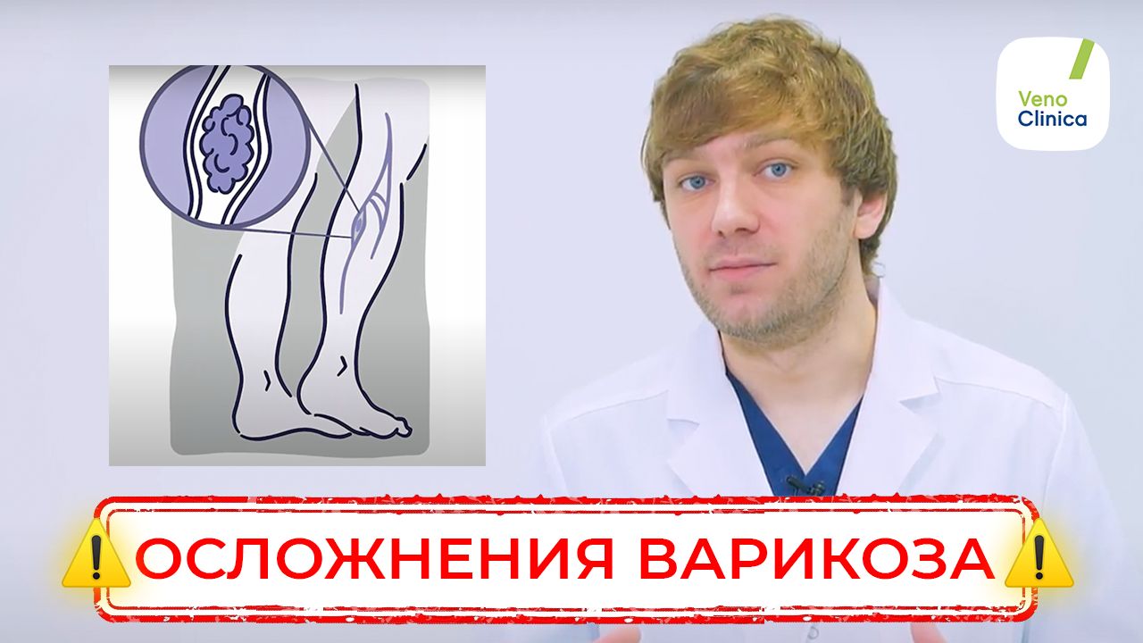 Осложнения ВАРИКОЗА! Почему не стоит откладывать лечение!
