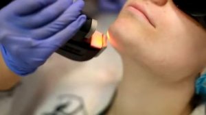 Лазерная эпиляция волос над губой и на подбородке