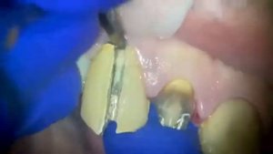 Снятие коронок под микроскопом. Временные клинические коронки.