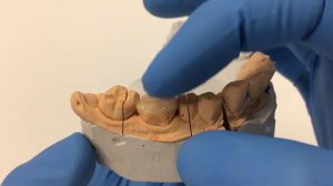 Керамическая пломба E.max на зуб