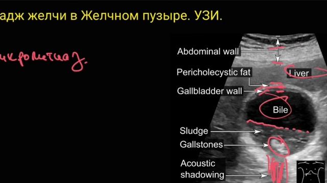 Сладж в желчном пузыре. смотреть онлайн
