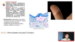 Патологическая анатомия | ВОСПАЛЕНИЕ