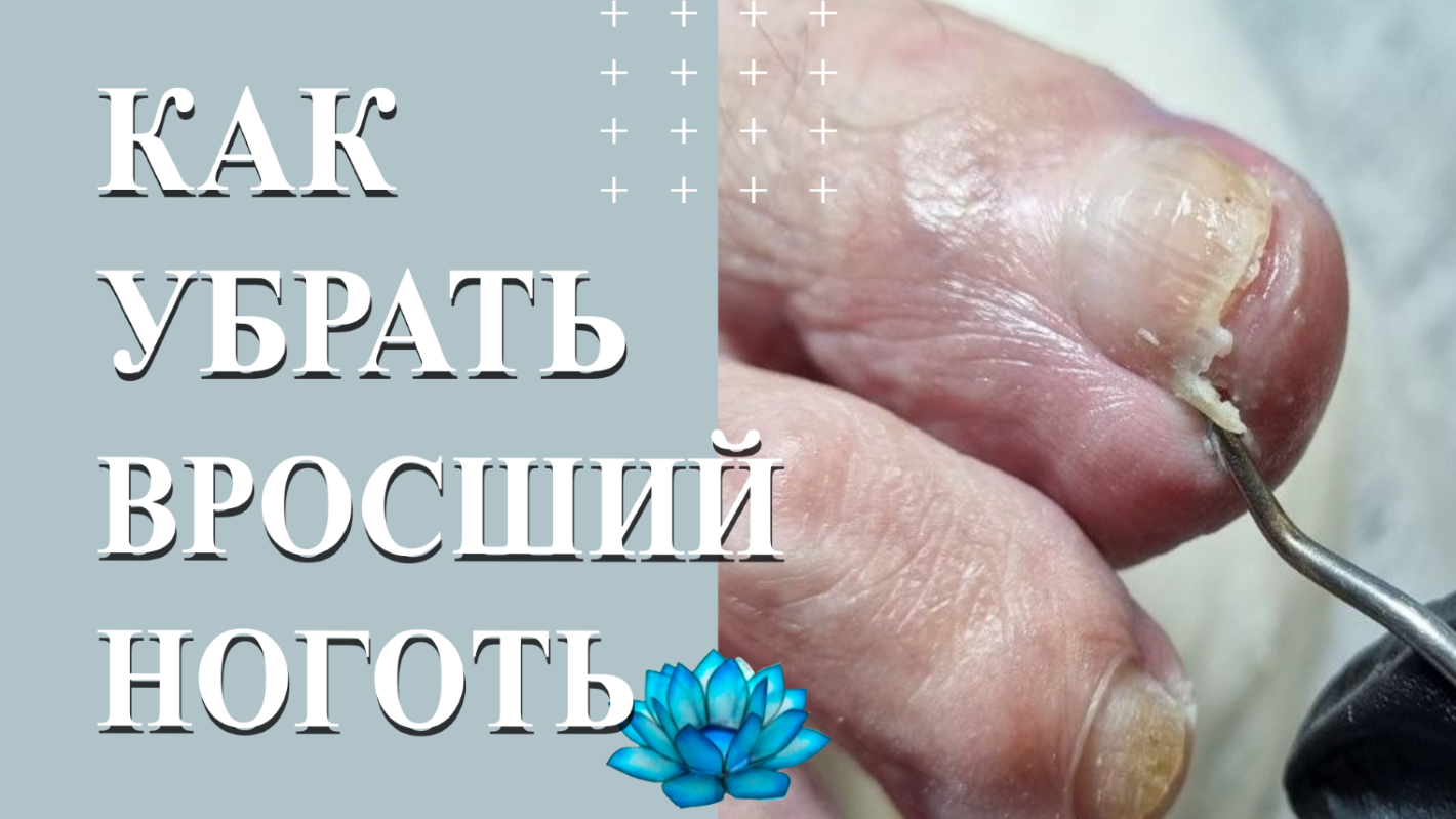 Удаление вросшего ногтя. Онихолизис ногтей. смотреть онлайн видео от ...