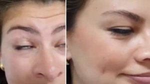 Ботокс с сохранением мимики - без эффекта замороженного лица