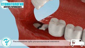 Удаление зуба мудрости без боли. Атравматичный метод.