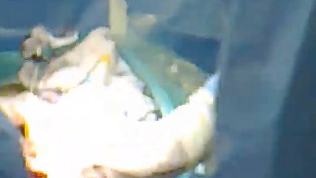 кесарево сечение 01. Ягодичное предлежание. caesarean section  .Breech presentation