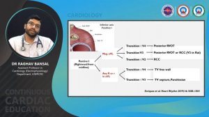 LOCALIZATION OF IDIOPATHIC VT - CCE - UNMICRC 03.09.2022