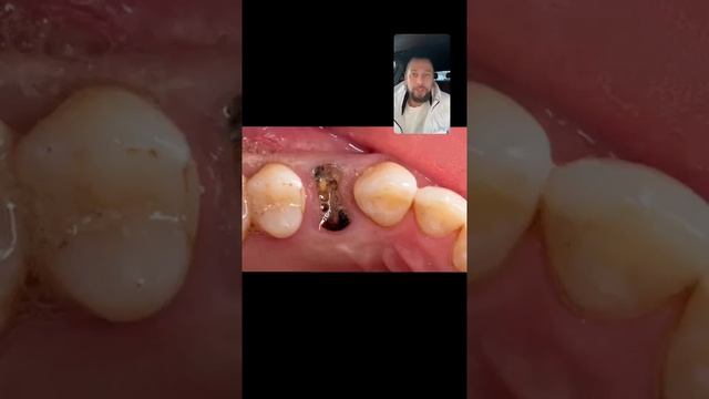 Удаление зуба и сразу установка имлантата , имплантация зубов в клинике МистерДент Фрязино , смотреть онлайн