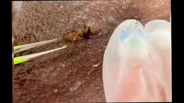 Вросший волос/ Удаление вросших волос в кожу / Вросший волос под кожей / Removing ingrown hairs