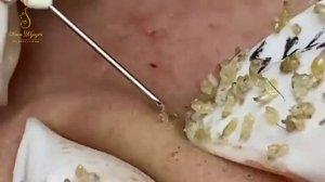 Blackhead Removal With Sac Dep Spa @10009
