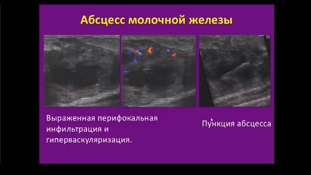 УЗИ молочной железы смотреть онлайн