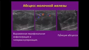 УЗИ молочной железы