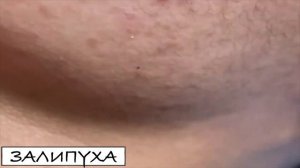 ПРЫЩИ 😍 ПРЫЩИ ВЫДАВЛИВАНИЕ 😍 ПОДБОРКА ВЫДАВЛИВАНИЕ ПРЫЩЕЙ #прыщи #acne #asmr