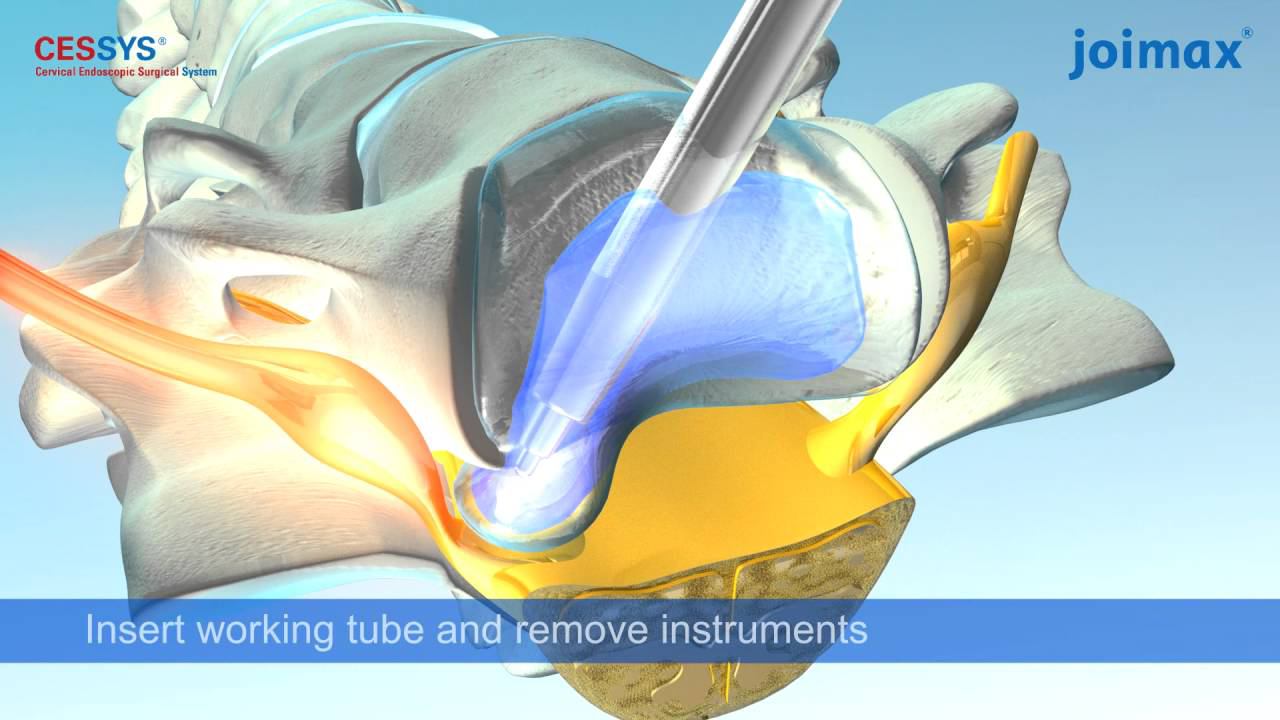 Анимационный ролик по удалению грыжи шеи CESSYS смотреть онлайн