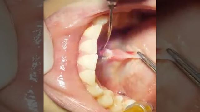 Подрезание уздечки языка лазером смотреть онлайн