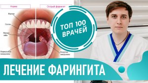 Лечение ФАРИНГИТА у взрослых и детей. Как и чем лечить фарингит острый и хронический