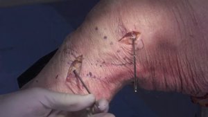 MCL Reconstruction with MILAGRO™ ADVANCE Interference Screw, SPEEDTRAP™ System & VERSALOOP™ Anchor