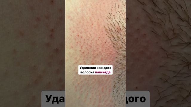 Электроэпиляция, в отличие от лазера и других видов эпиляции, удаляет волосы навсегда?