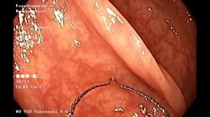 Cold snare polipectomy. Холодная петлевая полипэктомия