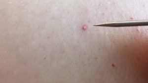 Гнойные прыщи на голове. Загноившийся корень волоса.