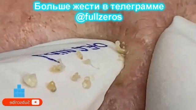 Новое! Выдавливание прыщей # Удаление черных точек 2021 # Прыщи выдавливание # Черная маска