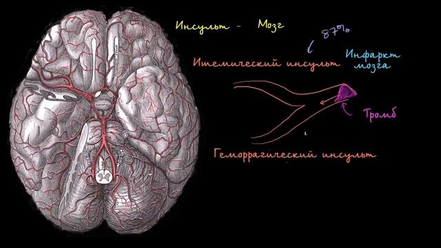 ИНСУЛЬТ.ПОДРОБНАЯ СХЕМА.КАК.ОТ ЧЕГО.ГДЕ.ПОЧЕМУ.КАК ПРОТЕКАЕТ.И ПРИЧИНЫ ВОЗНИКНОВЕНИЯ, ПРОСТЫМ ЯЗЫКО