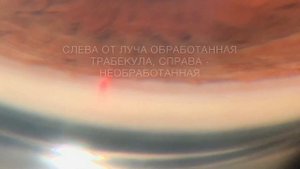 Как работает селективная лазерная трабекулопластика