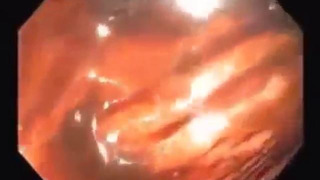 Кишечник здорового и больных людей!!! смотреть онлайн