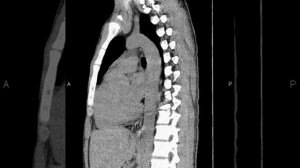 Альвеококкоз печени с узлами в легких