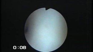 Эндометриоз тела матки. Гистероскопия.