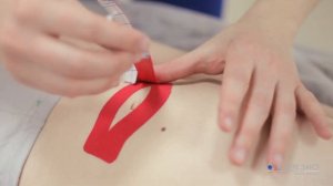 Кинезиотейпирование в педиатрии