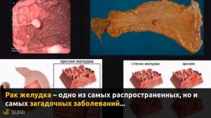 Рак желудка