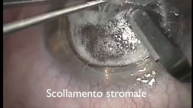 Video intervento: DALK (Trapianto di cornea lamellare anteriore) смотреть онлайн