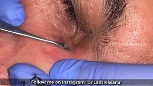 35 YEARS OLD DEEP BLACKHEAD REMOVAL BY DR.LALIT KASANA / NEW BLACKHEAD VIDEO