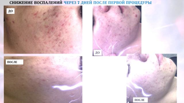 РезультатыШлифовкиИмпульснымСпреемИРучногоМассажа