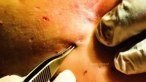 Подборка прыщи, гнойники, угри, жировики, классное выдавливание!Выдавливание прыщей.